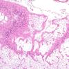 9D4 Infarcts, multiple, HT, dementia (Case 9) N20 H&E 1