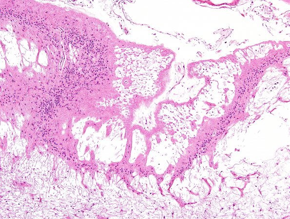 9D4 Infarcts, multiple, HT, dementia (Case 9) N20 H&E 1