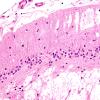 9D5 Infarcts, multiple, HT, dementia (Case 9) N20 H&E 2.