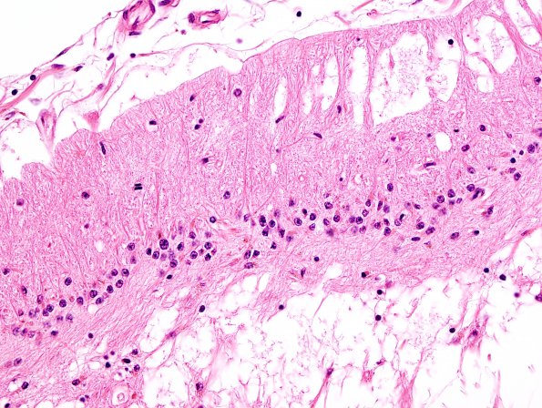 9D5 Infarcts, multiple, HT, dementia (Case 9) N20 H&E 2.