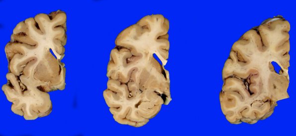 1A2 Vascular dementia (Case 1) 25