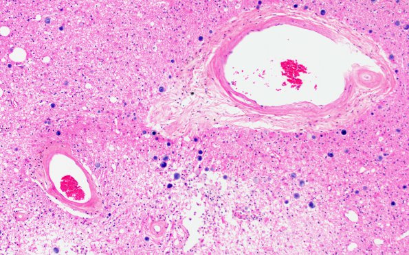 1B1B Binswanger's Dz (Case 1) R36 H&E 20X 1
