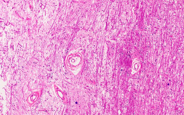 1B2C Binswanger's Dz (Case 1) L27 H&E 10X