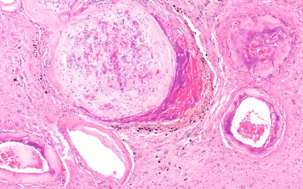 1B5C Vascular dementia (Case 1) R35 H&E 10X