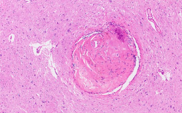 1C3 Binswanger's Dz (Case 1) H&E 10X 2