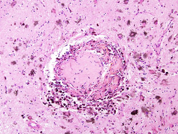 1C9 Charcot Bouchard (Case 1) L17 H&E 4