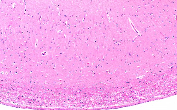 1E2 Binswanger's Dz (Case 1) L5 H&E CA1 10X