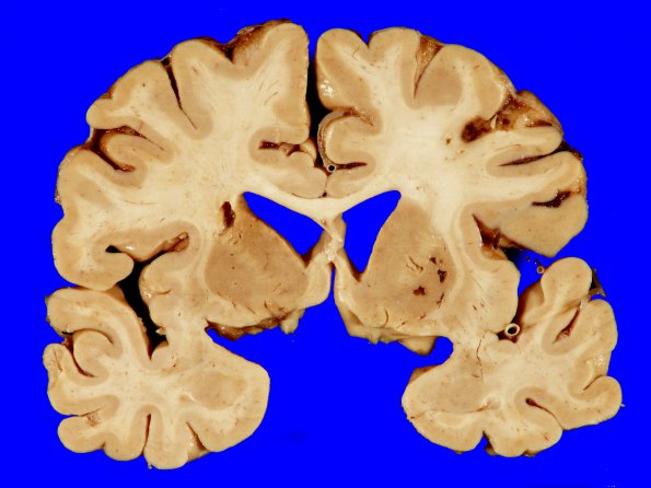 2A1 Binswanger's Dz (Case 2) 2