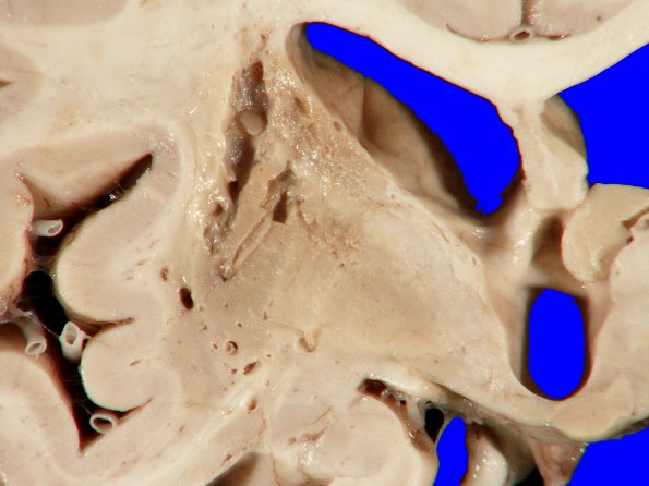 2A4 Binswanger's Dz (Case 2) 5