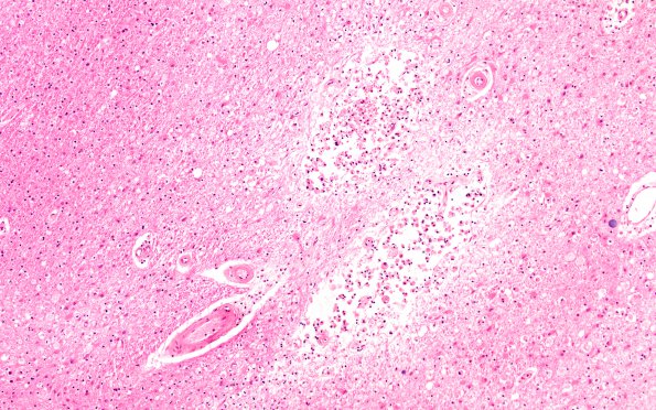 2B2 Binswanger's Dz (Case 2) H&E N5 10X 2