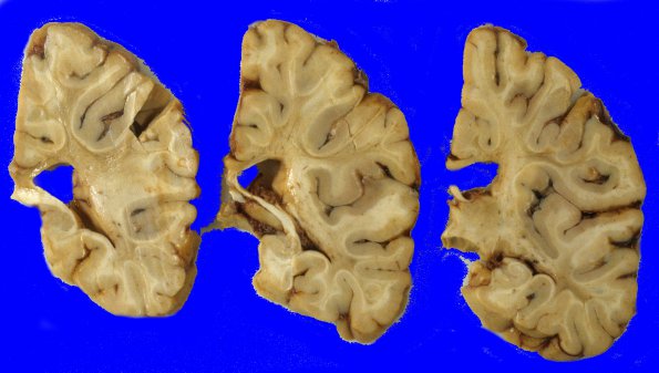 3A4 Binswanger's Dz (Case 3) 7