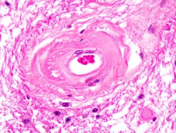 4B3 Arteriolosclerosis (Case 4) 3