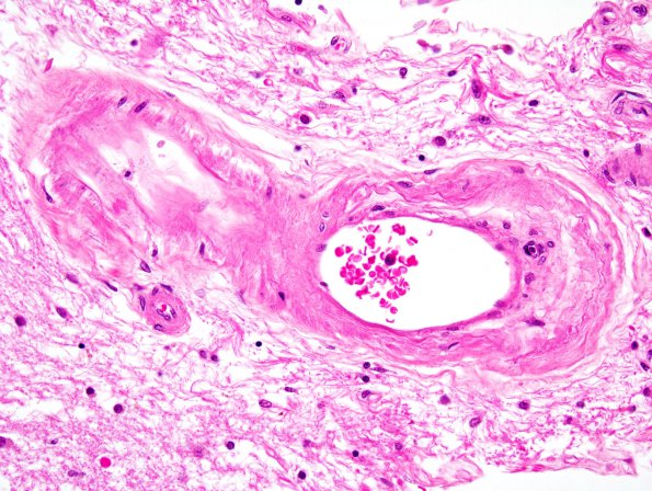 4B4 Arteriolosclerosis (Case 4) 1