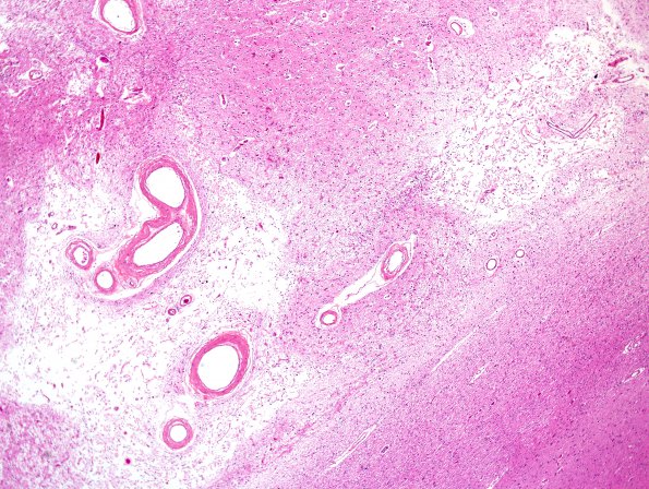 4D2 Binswanger's Dz (Case 4) basal ganglia H&E 2