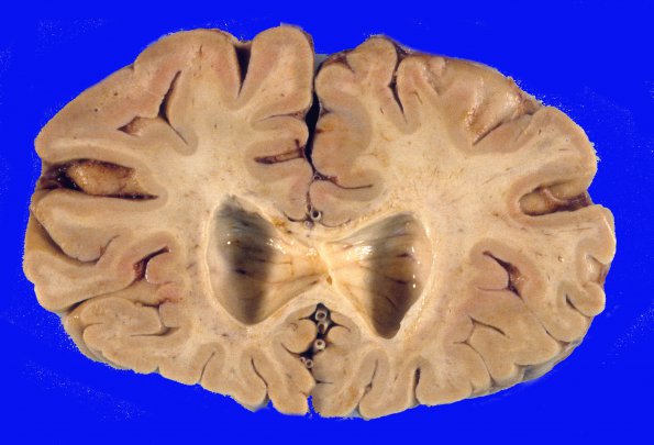 5A1 Vascular Dementia (Case 5) 5