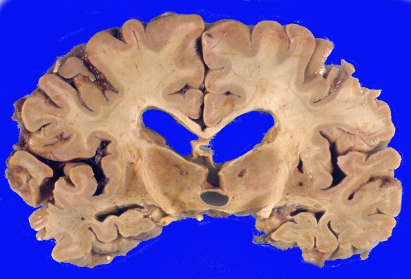 5A2 Vascular Dementia (Case 5) 6