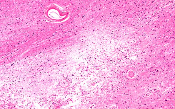 6B2 (Case 6) H&E 10X 1