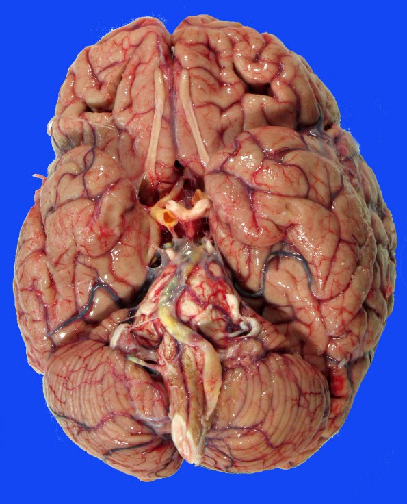 7A1 Binswanger (Case 7)_02