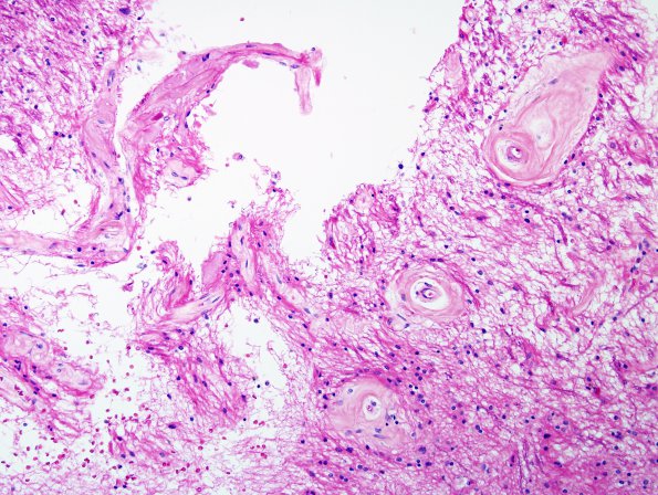 7B4 Vascular dementia (Case 7) H&E