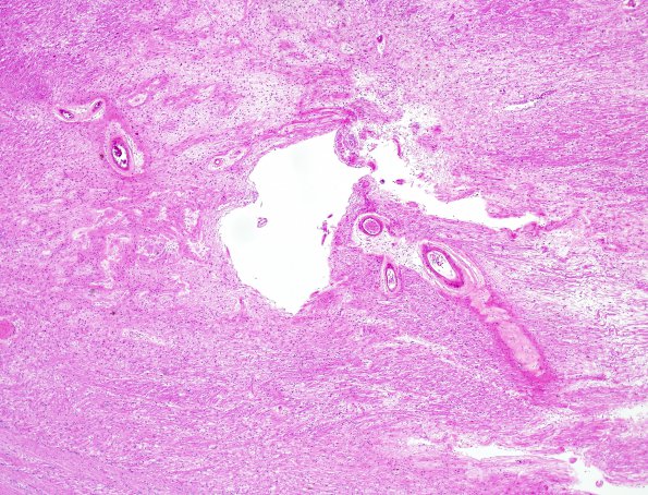 7B5 Vascular dementia (Case 7) H&E 5