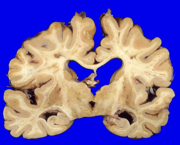 8A1 Dementia (Case 8) 1