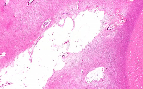 8B2 Dementia (Case 8) N11 H&E 2X