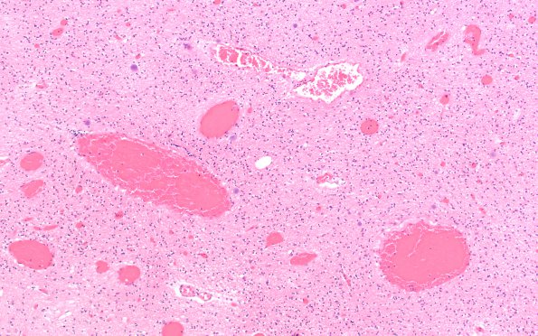 10B4 Telangiectasis (Case 10) N15 H&E 3