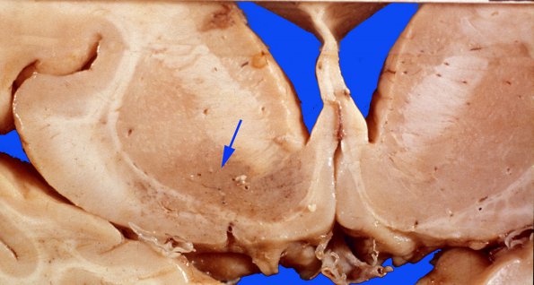 11 Telangiectasis (Case 11) copy