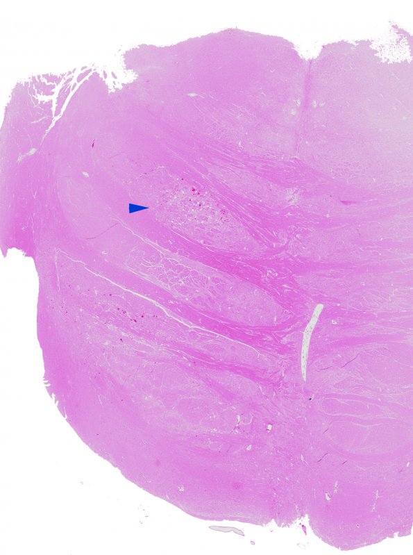 12A1 Telangiectasis (Case 12) H&E 1 copy