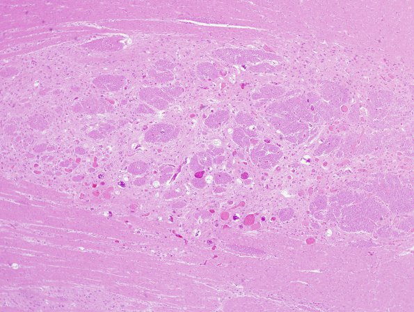 12A2 Telangiectasis (Case 12) H&E 6