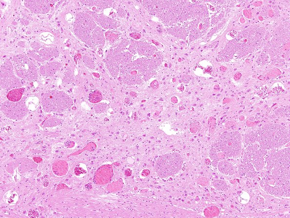 12A3 Telangiectasis (Case 12) H&E 5