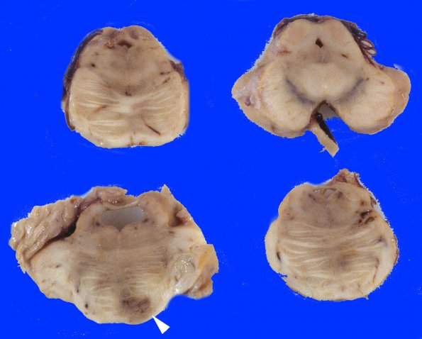 13A Telangiectasis (Case 13) copy