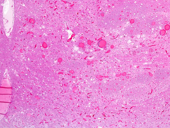 13B2 Telangiectasis (Case 13) H&E 4X.jpg