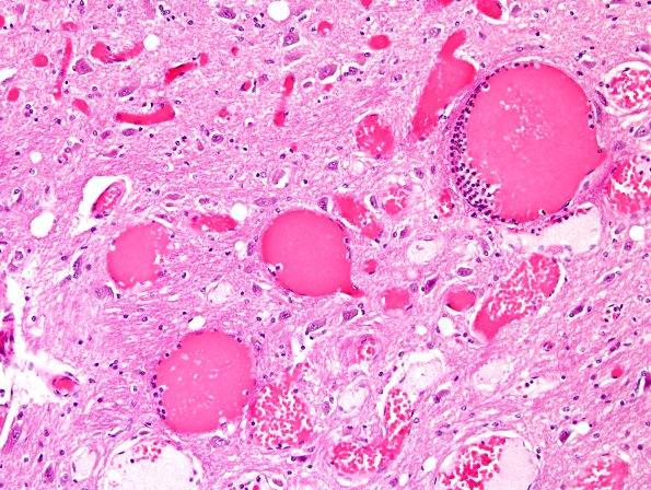 13B3 Telangiectasis (Case 13) H&E 10X.jpg