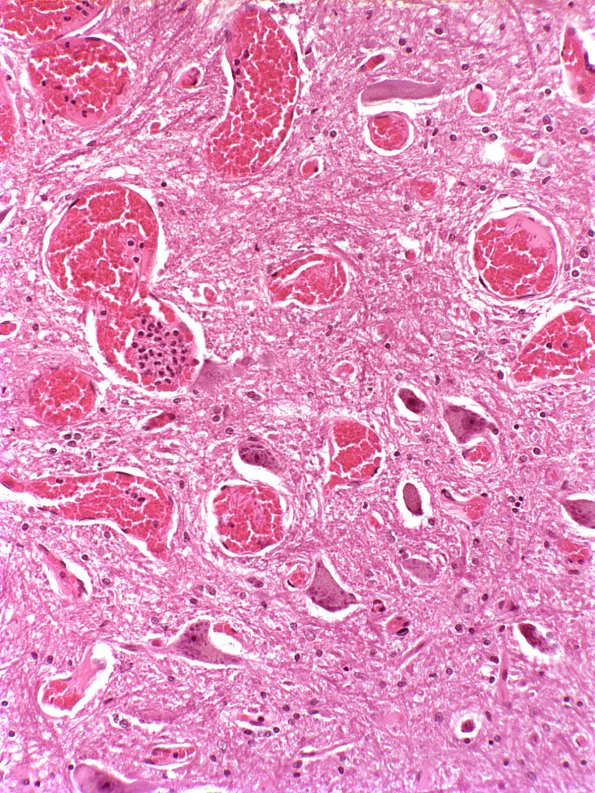 15A2 Telangiectasis vs DVA (Case 15) H&E a