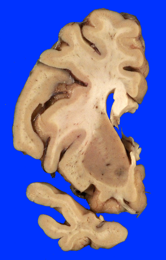 17A Telangiectasis BG L6 (Case 17) 1