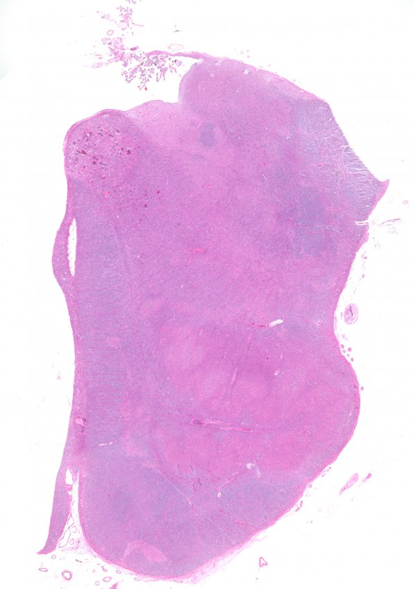 18A1 Telangiectasis (Case 18) H&E  WM