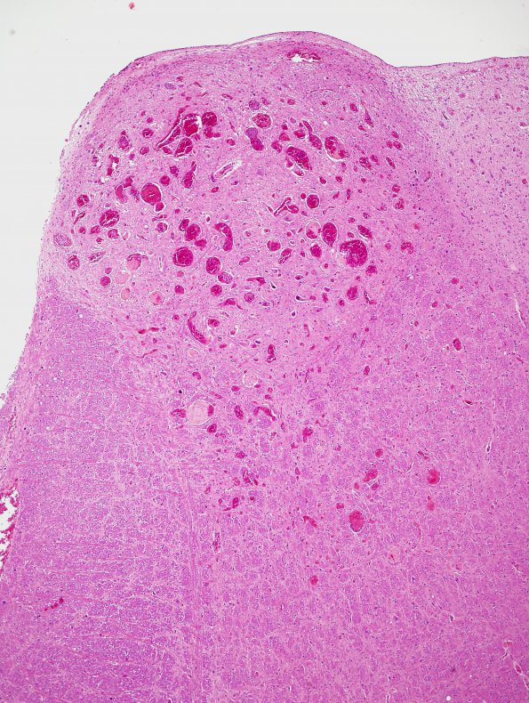 18A2 Telangiectasis (Case 18) H&E 3