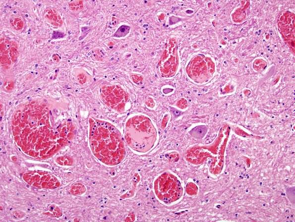 18A4 Telangiectasis (Case 18) H&E 1