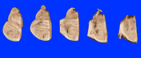 19A Telangiectasis, hyalinized (Case 19) Gross_2