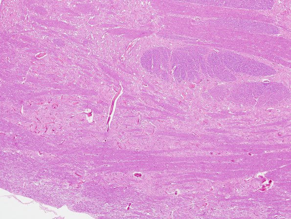19B2 Telangiectasis, hyalinized (Case 19) H&E 12