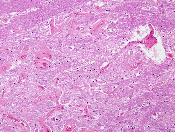 19B3 Telangiectasis, hyalinized (Case 19) H&E 5