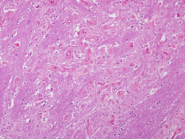 19B4 Telangiectasis, hyalinized (Case 19) H&E 8