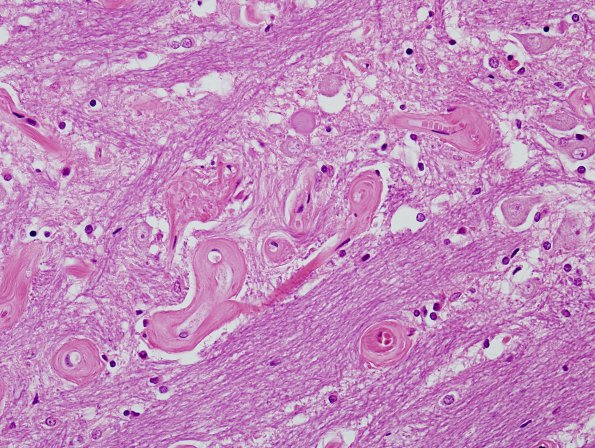 19B5 Telangiectasis, hyalinized (Case 19) H&E 11