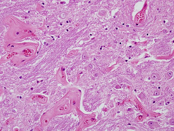 19B6 Telangiectasis, hyalinized (Case 19) H&E 2