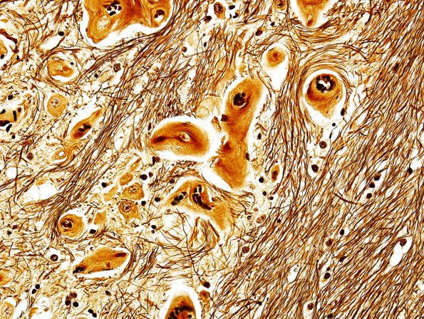 19C2 Telangiectasis, hyalinized (Case 19) BIels 6