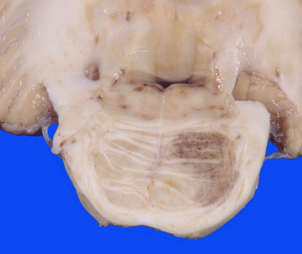 1A2 Telangiectasis (Case 1) 1