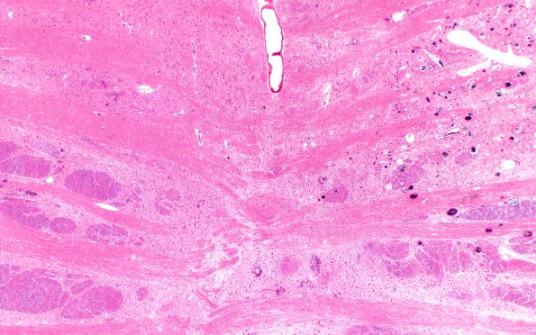 1B2 Telangiectasis (Case 1) 3