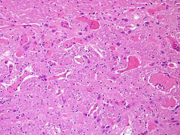 20A4 Telangiectasis, MSA (Case 20) N7 H&E 2.jpg