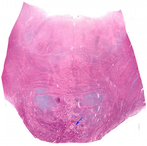 22B1 Telangiectasis (Case 22) N14 H&E WM copy